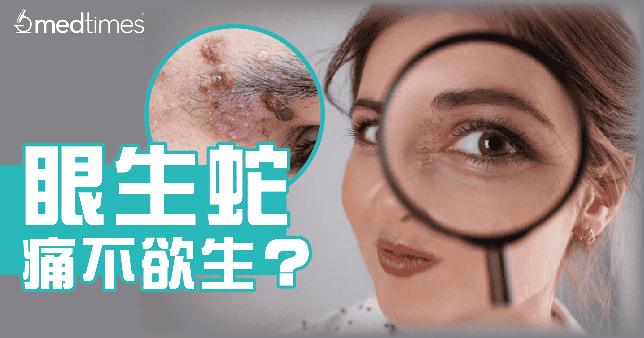 【生蛇须知】眼生蛇痛不欲生？了解成因与预防！
